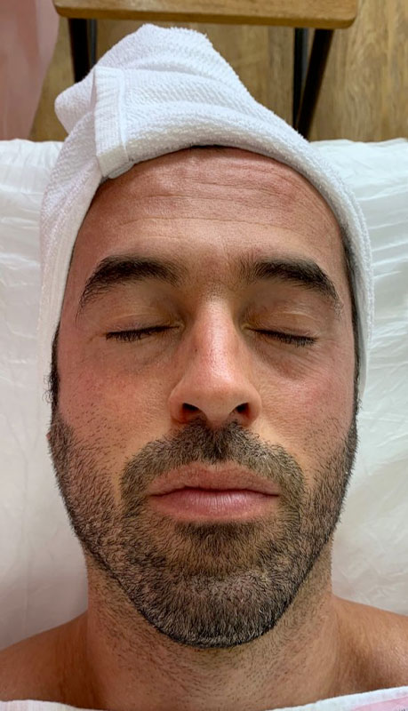 Client before treatment